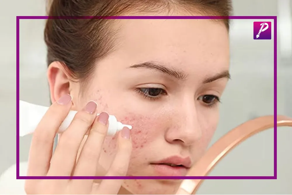 درمان جوش صورت 
